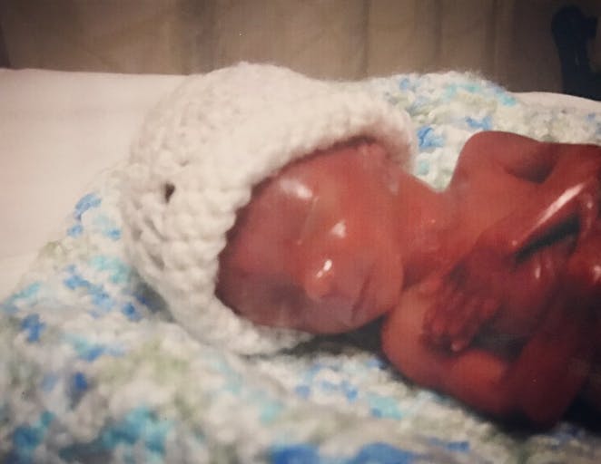 Sweet Luke Jacobs was born prematurely at 18 and a half weeks gestation and is greatly loved by his parents. Photo courtesy of Meghann Jacobs.