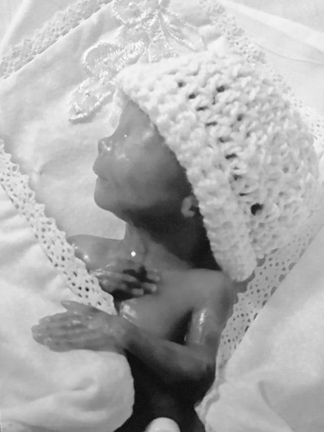 Baby Luke, after his premature birth at 18 and a half weeks gestation. Photo courtesy of Meghann Jacobs. Baby Luke, after his premature birth at 18 and a half weeks gestation. Photo courtesy of Meghann Jacobs.