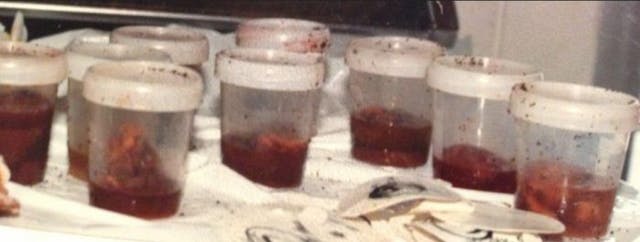 Containers holding early suction aborted babies found in a trash dumpster. Image: Aborted babies after suction abortion