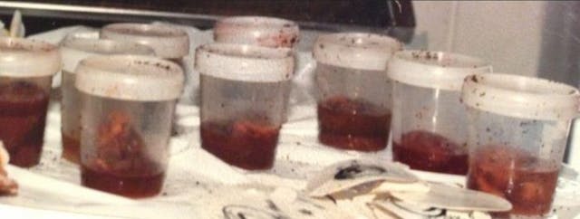 Image: Aborted babies after suction abortion