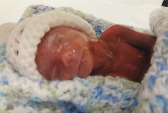 Premature baby Luke was born at 18 and a half weeks gestation. Photo courtesy of Meghann Jacobs. Premature baby Luke was born at 18 and a half weeks gestation. Photo courtesy of Meghann Jacobs.