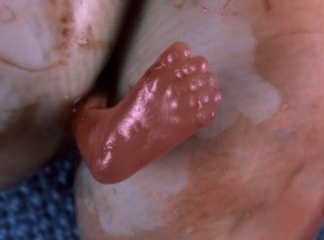 Abortion at 8 weeks (Image credit: AbortionNo.org) Abortion at 8 weeks (Image credit: AbortionNo.org)