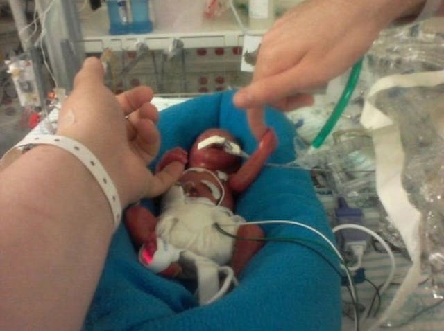 Micah Pickering, now a healthy 3-year-old, was born at 22 weeks gestation in 2012.