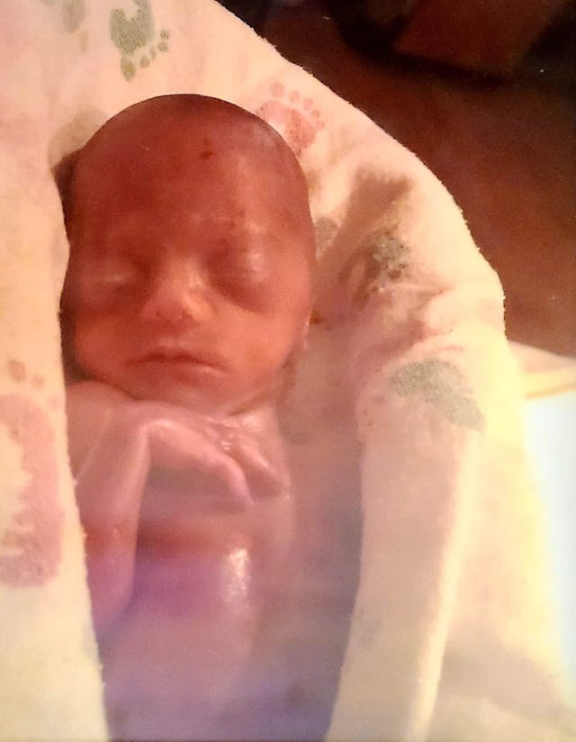 Baby Sophia at birth at 22 weeks. Courtesy Matesi Joy Neumiller. Baby Sophia at birth at 22 weeks. Courtesy Matesi Joy Neumiller.