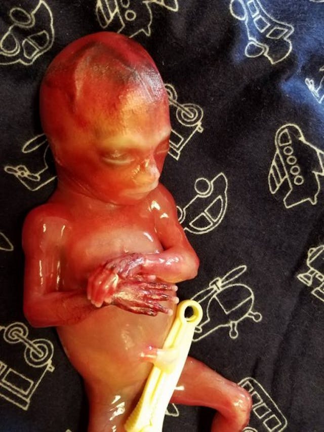 Baby Zane was born early at 19 weeks gestation. via Facebook Baby Zane was born early at 19 weeks gestation.