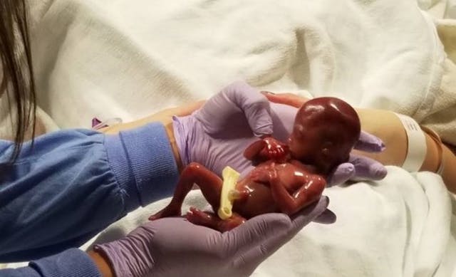 Family shares powerful photos of baby born at 19 weeks image