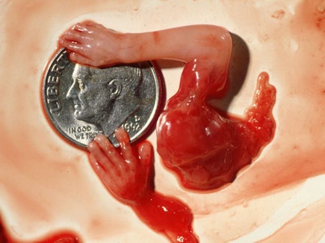 10 weeks. abortion