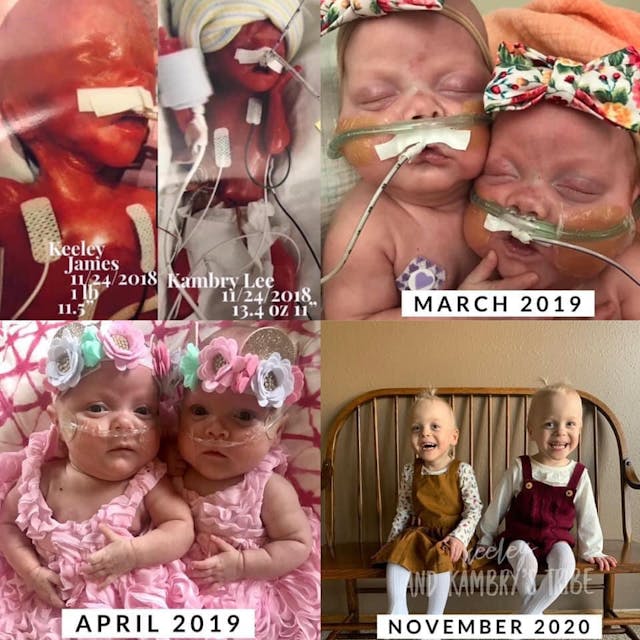 Prenatal surgery for twin-to-twin transfusion syndrome is saving lives image