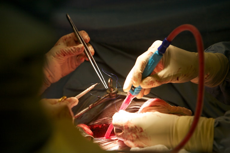 Kidney transplant surgery