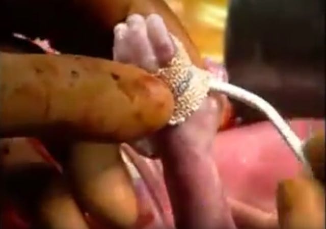 Stunning fetal surgery images offer amazing glimpse of baby in the womb image