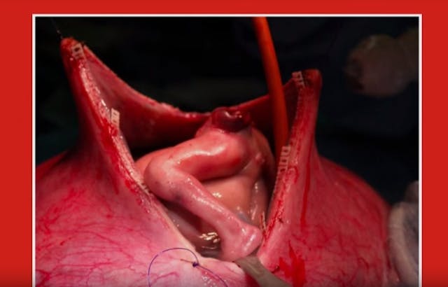 Stunning fetal surgery images offer amazing glimpse of baby in the womb image