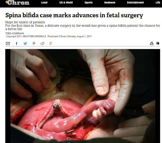 Houston Chronicle Open Fetal Surgery (Photo: Karen Warren, Houston Chronicle) Stunning fetal surgery images offer amazing glimpse of baby in the womb image