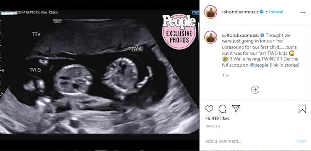 Singer Colton Dixon says one of his twin daughters had no pulse at birth: ‘It felt like a lifetime’ image