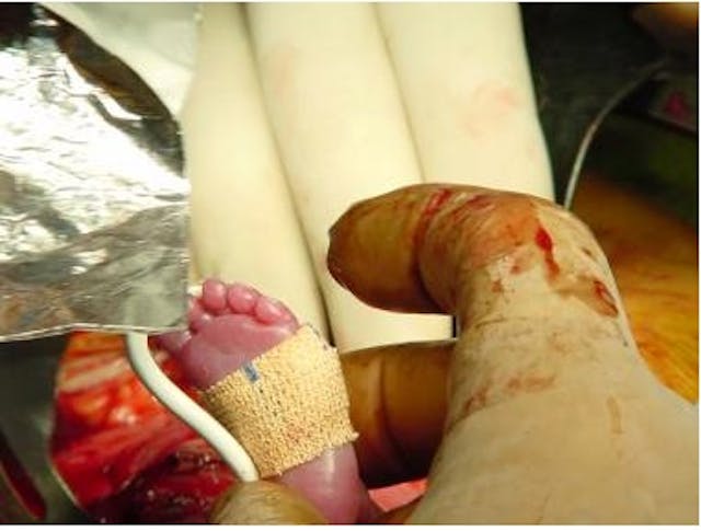 Pulse oximeter placed on foot of fetus (image: Dr Douglas Miniati and Dr Payam Saadai, Division of Pediatric Surgery, University of California, San Francisco, School of Medicine) Stunning fetal surgery images offer amazing glimpse of baby in the womb image