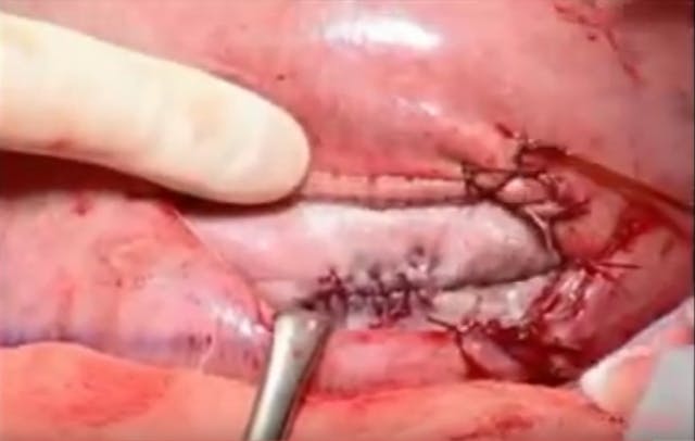 Fetal Surgery spine of preborn baby Stunning fetal surgery images offer amazing glimpse of baby in the womb image