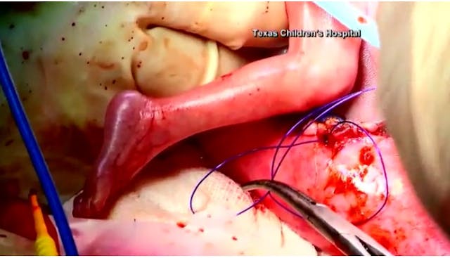 Fetal Surgery – tumor removed Stunning fetal surgery images offer amazing glimpse of baby in the womb image
