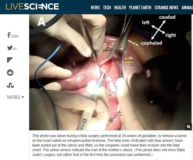 Stunning fetal surgery images offer amazing glimpse of baby in the womb image