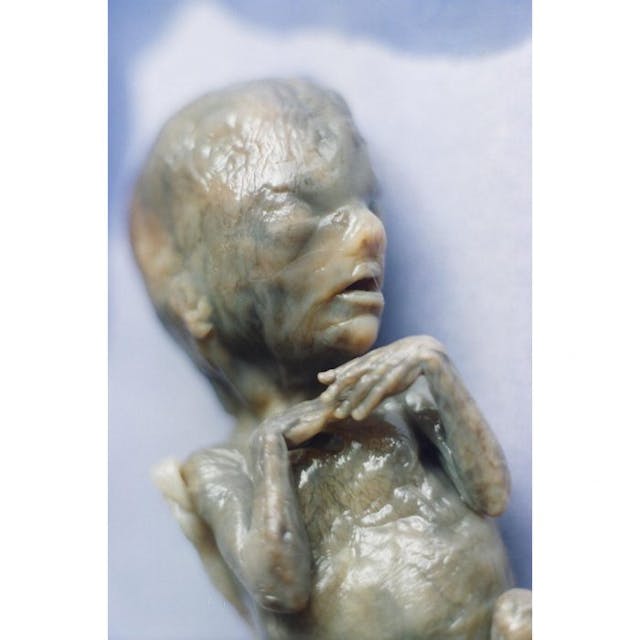 This child was aborted at 18 weeks gestation using the saline abortion method – note the burned skin. (Images courtesy of ProLifeSociety.com and ImagesOfAbortion.com) This child was aborted at 18 weeks gestation using the saline abortion method - note the burned skin.