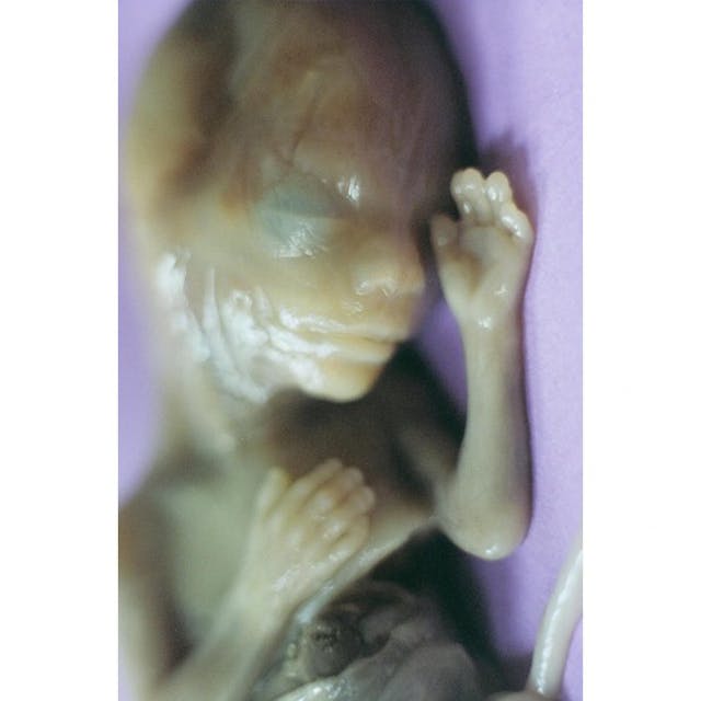 This preborn child was aborted at 21 weeks gestation through a Prostaglandin abortion. (Images courtesy of   and  ) This preborn child was aborted at 21 weeks gestation through a Prostaglandin abortion.