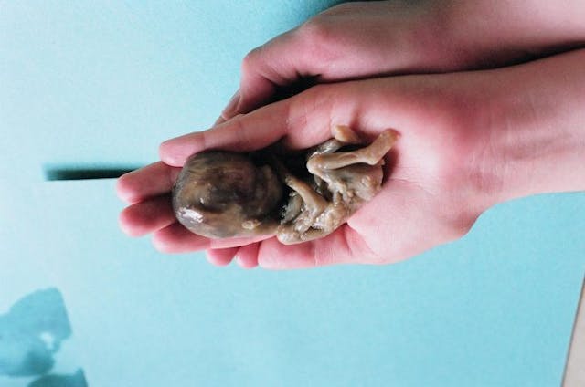 This 21-week old preborn child was killed through a prostaglandin abortion. (Images courtesy of   and  ) This 21-week old preborn child was killed through a prostaglandin abortion.