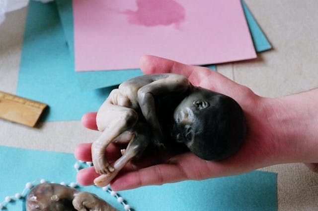This 24-week old preborn child died due to a prostaglandin abortion.