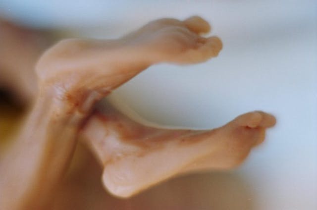 The tiny feet of a 21-week old preborn child killed by a prostaglandin abortion.