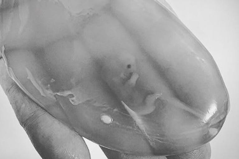 nine week miscarriage instagram