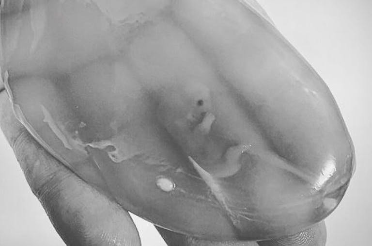 nine week miscarriage instagram