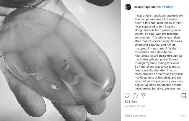 Photo: Instagram Miscarriage Stories Mother shares remarkable image of her baby miscarried at nine weeks gestation image