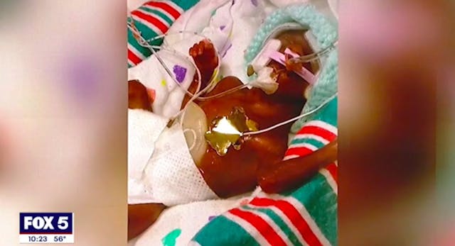 screenshot: Fox5. Jermarius was born at 21 weeks. premature baby
