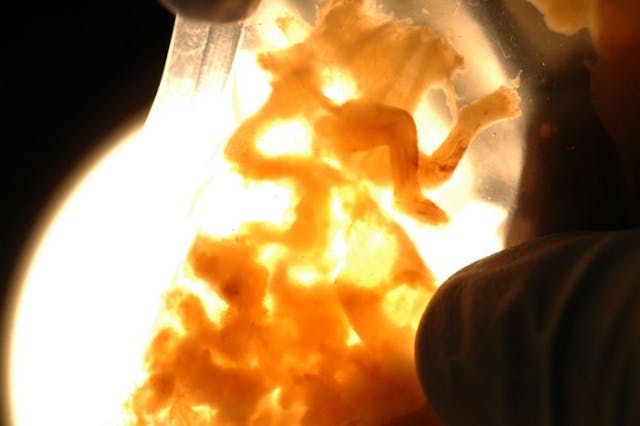 6 powerful images that show the reality of abortion in the first trimester image