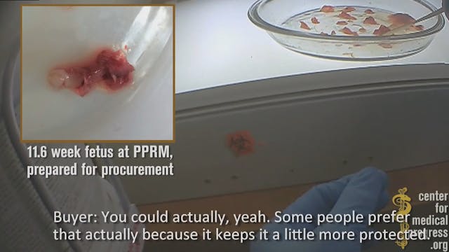 Planned Parenthood staff examine the human fetal remains following an abortion at 11 weeks. Source: The Center for Medical Progresss. Planned Parenthood staff examine the human fetal remains following an abortion at 11 weeks. Source: The Center for Medical Progresss.