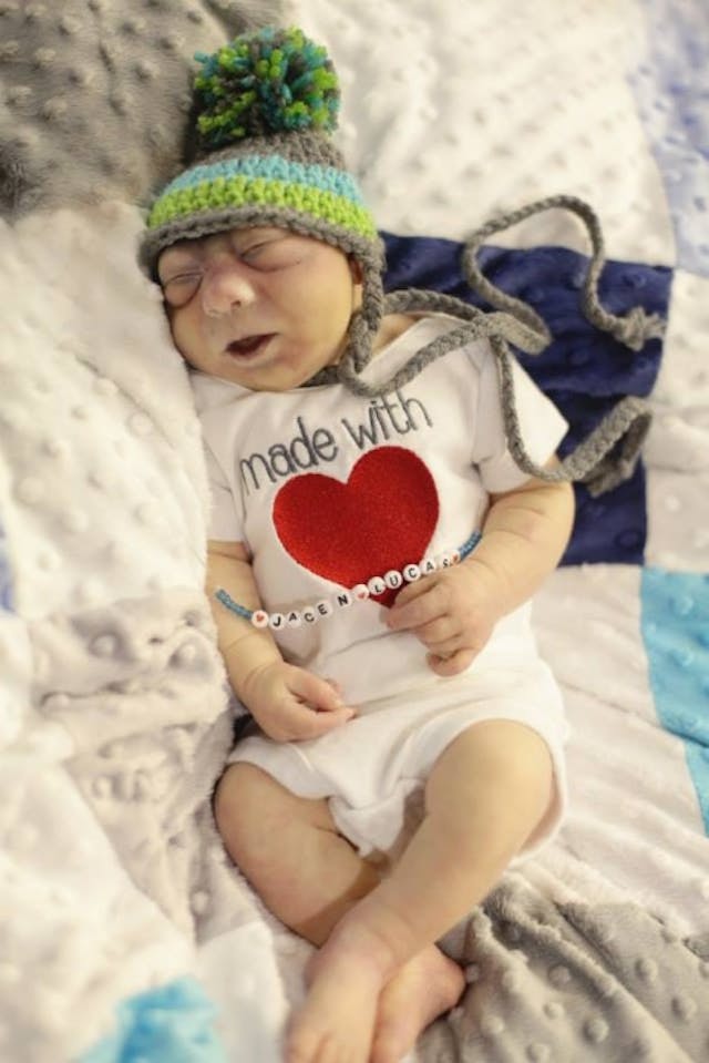 Baby Jacen lived 27 hours after birth Angela and Gabriel, born with anencephaly, show why every child deserves protection image