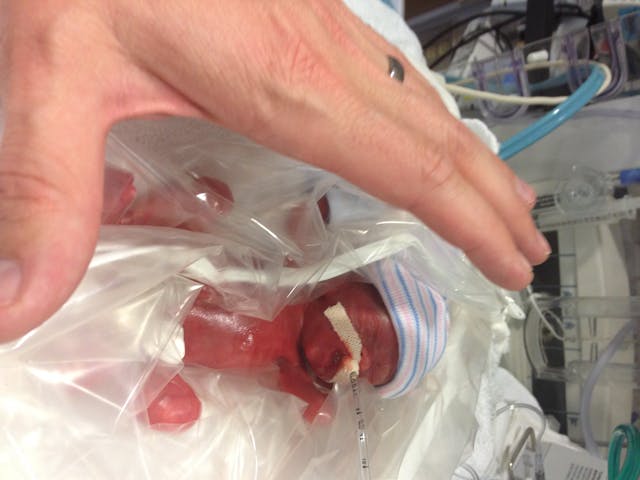 The first photo taken of Naomi on the day of her birth weighing just 364 grams. Photo courtesy of Angela Bakker. Preemie of the Week: Naomi, born weighing 364 grams, has inspired others to choose life image