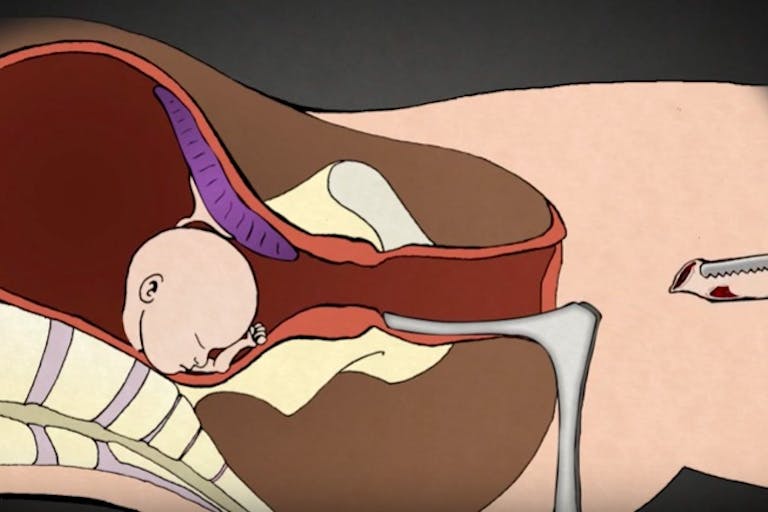 D&E abortion pulls baby apart piece by piece, Go to www.AbortionProcedures.com for facts on abortion