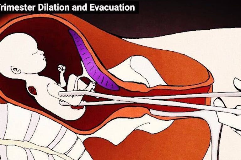 D&E abortion