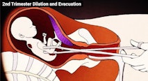 D&E abortion