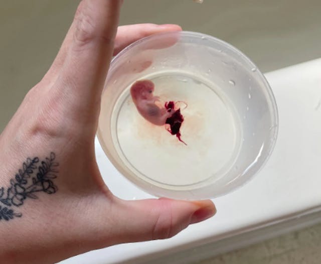 Reddit user BackgroundPea7785’s photo of aborted baby at 9 weeks gestation Reddit user BackgroundPea7785’s photo of aborted baby at 9 weeks gestation