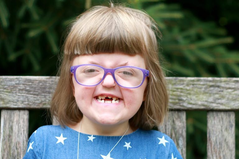 Sarah, craniofacial abnormalities, Apert syndrome
