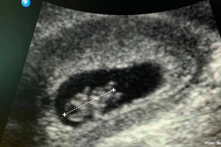 abortion pill reversal