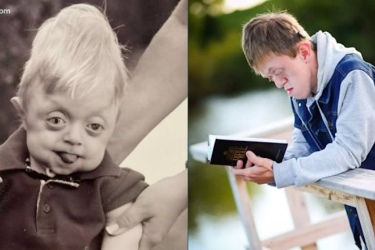 hospice, graduation, Pfeiffer syndrome
