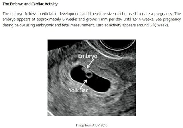 Embryo has “cardiac activity” by 6 weeks (TEACH abortion training curriculum, 2022) Image: Embryo has cardiac activity by 6 weeks (TEACH abortion training curriculum, 2022)