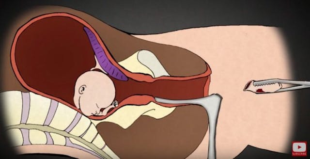 Planned Parenthood abortionists describe in gruesome detail how they abort preborn children image