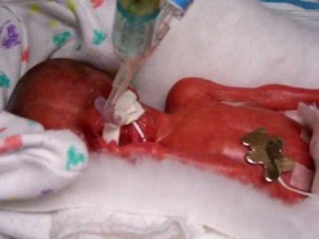 (Baby born at 24 weeks; photo via ccoli.com) (via eccoli.com)