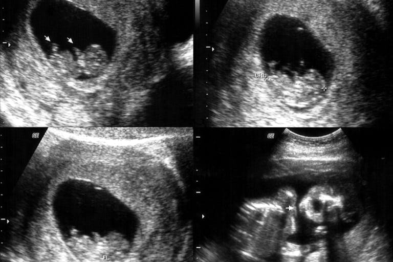 ultrasounds-baby-black