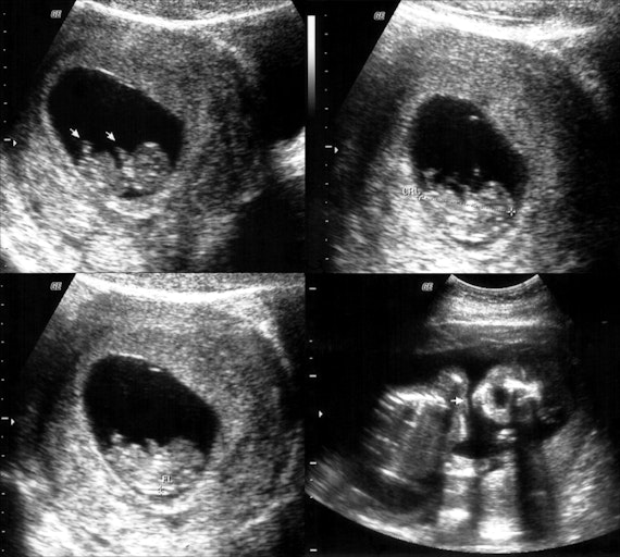 ultrasounds-baby-black