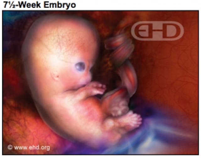 More real photos at www.ehd.org