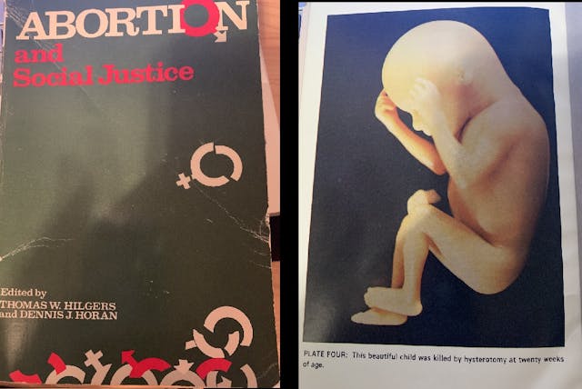 Image: Hysterotomy abortion at twenty weeks (Image: Abortion and Social Justice with credit to Russell Sacco, M.D.)