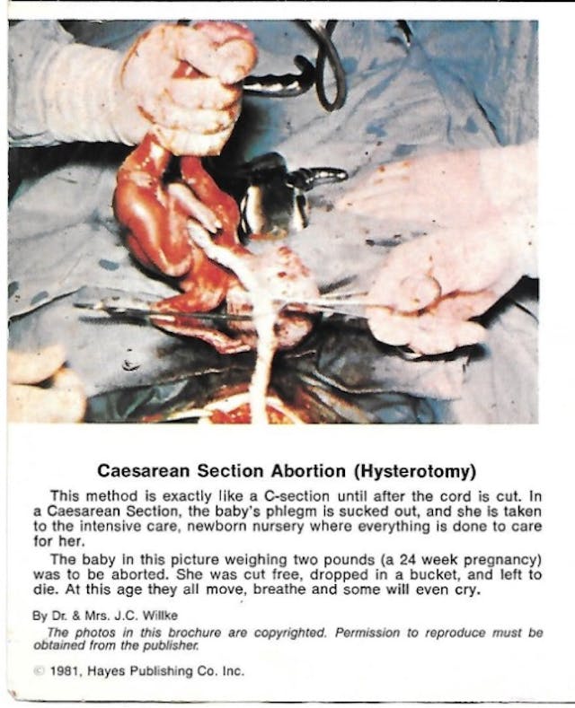Hysterotomy abortion a (Image: pamphlet Life or Death Hayes Publishing) Image: Hysterotomy abortion a (Image: pamphlet Life or Death Hayes Publishing)