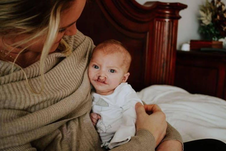 cleft lip palate abortion via facebook